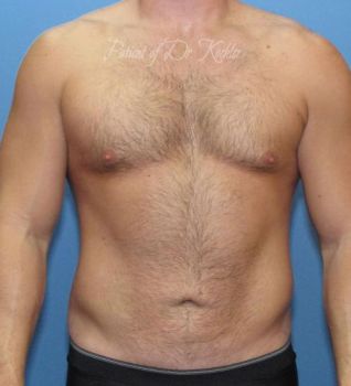 Liposuction Patient Photo - Case 83 - after view