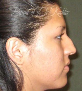 Rhinoplasty Patient Photo - Case 90 - before view-1