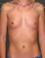 Breast Augmentation - Case 46 - Before