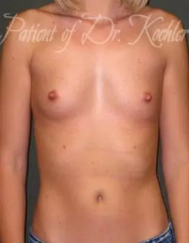 Breast Augmentation Patient Photo - Case 46 - before view-