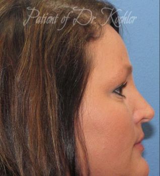 Brow Lift Patient Photo - Case 71 - after view-1