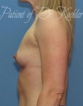 Breast Augmentation Patient Photo - Case 35 - before view-1