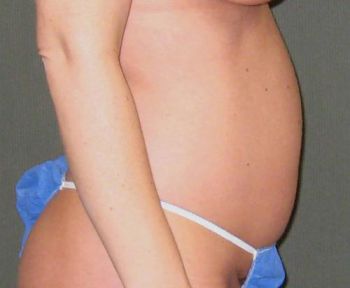 Tummy Tuck Patient Photo - Case 101 - before view-1