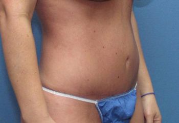 Tummy Tuck Patient Photo - Case 101 - after view-2