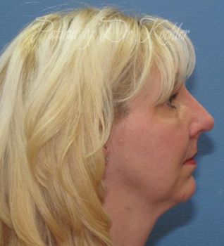 Rhinoplasty Patient Photo - Case 87 - after view-1