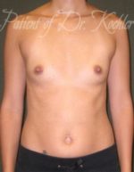 Breast Augmentation - Case 47 - Before