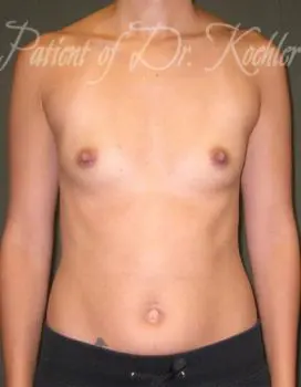 Breast Augmentation Patient Photo - Case 47 - before view-0
