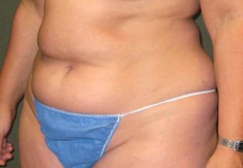 Tummy Tuck Patient Photo - Case 96 - before view-2