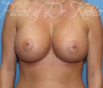 Breast Augmentation Patient Photo - Case 33 - after view-0