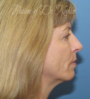 Cheek Implant Patient Photo - Case 73 - after view-1