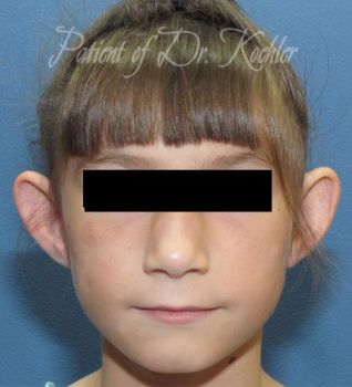 Ear Surgery Patient Photo - Case 75 - before view-