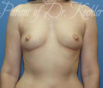 Breast Augmentation Patient Photo - Case 41 - before view-0