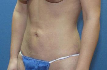 Tummy Tuck Patient Photo - Case 100 - before view-2