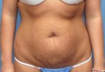 Liposuction - Case 98 - Before