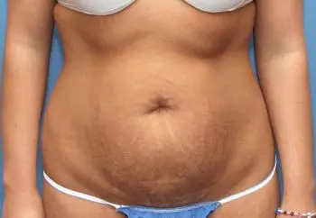 Liposuction Patient Photo - Case 98 - before view-