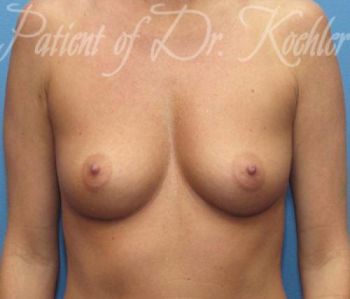 Breast Augmentation Patient Photo - Case 33 - before view-