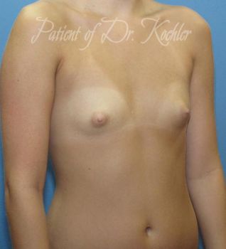 Breast Augmentation Patient Photo - Case 52 - before view-2