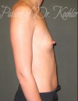Breast Augmentation Patient Photo - Case 47 - before view-1