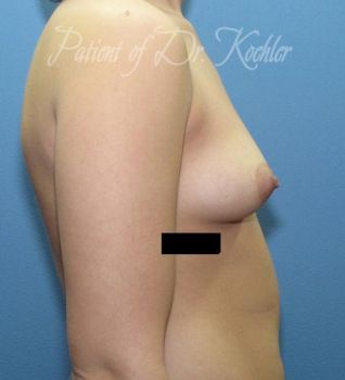 Breast Augmentation Patient Photo - Case 49 - before view-1