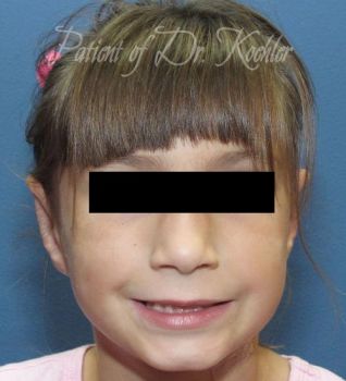 Ear Surgery Patient Photo - Case 75 - after view-0