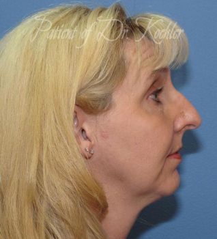 Rhinoplasty Patient Photo - Case 87 - before view-1