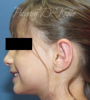 Ear Surgery Patient Photo - Case 75 - after view-1
