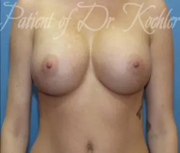 Breast Augmentation Patient Photo - Case 37 - after view-0