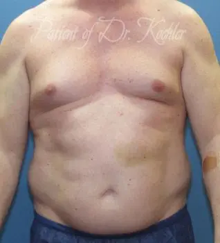 Liposuction Patient Photo - Case 81 - before view-0