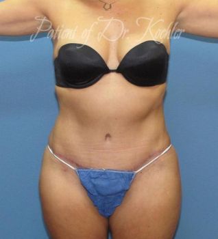 Liposuction Patient Photo - Case 82 - after view