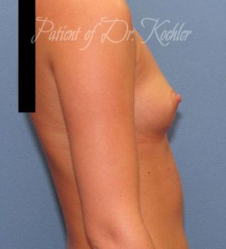 Breast Augmentation Patient Photo - Case 51 - before view-1