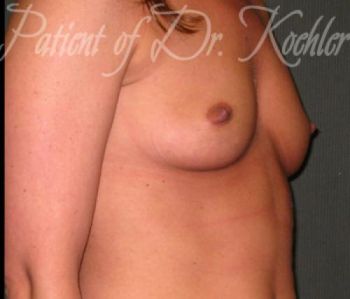 Breast Augmentation Patient Photo - Case 21 - before view-2