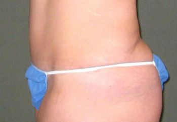 Tummy Tuck Patient Photo - Case 96 - after view-1