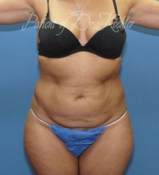 Liposuction Patient Photo - Case 82 - before view-
