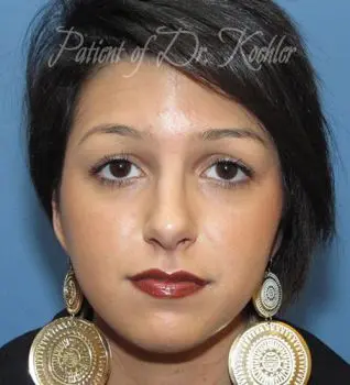 Rhinoplasty Patient Photo - Case 89 - after view