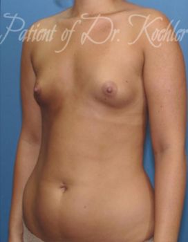 Breast Augmentation Patient Photo - Case 16 - before view-2