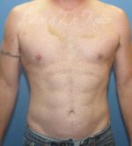 Liposuction - Case 80 - After