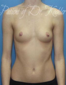 Breast Augmentation Patient Photo - Case 17 - before view-0
