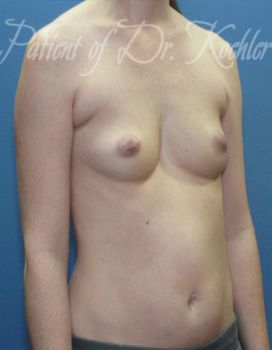 Breast Augmentation Patient Photo - Case 36 - before view-2