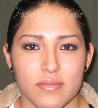 Rhinoplasty Patient Photo - Case 90 - before view-