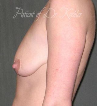 Breast Augmentation/Lift Patient Photo - Case 65 - before view-1