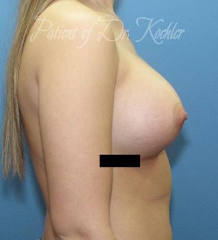 Breast Augmentation Patient Photo - Case 49 - after view-1