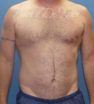 Liposuction Patient Photo - Case 80 - before view-