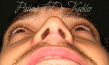 Rhinoplasty Patient Photo - Case 91 - before view-1