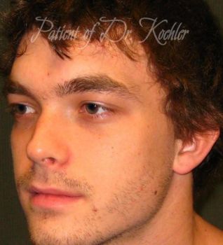 Rhinoplasty Patient Photo - Case 91 - after view-3