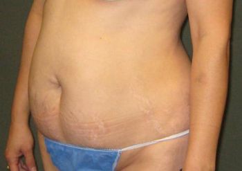 Tummy Tuck Patient Photo - Case 99 - before view-1