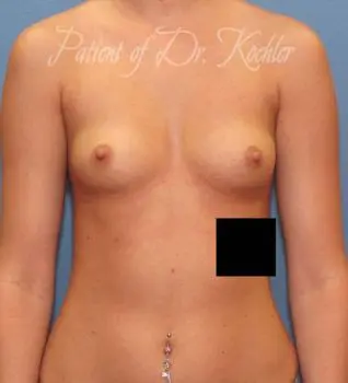 Breast Augmentation Patient Photo - Case 51 - before view-0