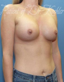 Breast Augmentation Patient Photo - Case 44 - after view-2