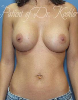Breast Augmentation Patient Photo - Case 32 - after view-0