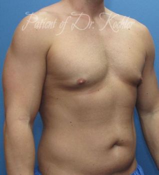Liposuction Patient Photo - Case 83 - before view-1