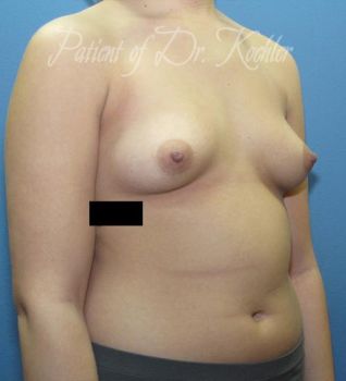 Breast Augmentation Patient Photo - Case 49 - before view-2